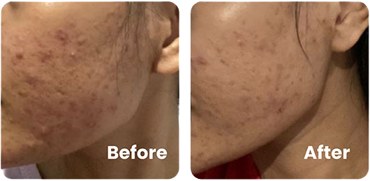Before After 3-in-1 Acne Treatment Serum