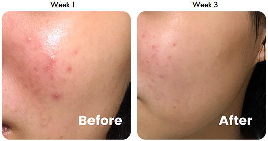Testimonial 3-in-1 Acne Treatment Serum