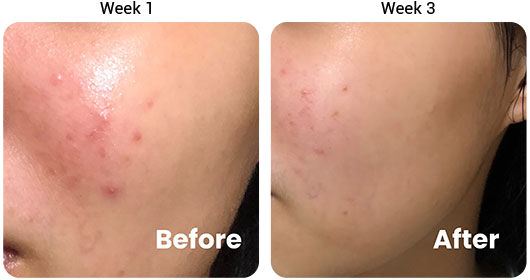 Testimonial 3-in-1 Acne Treatment Serum