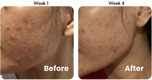 Testimonial 3-in-1 Acne Treatment Serum