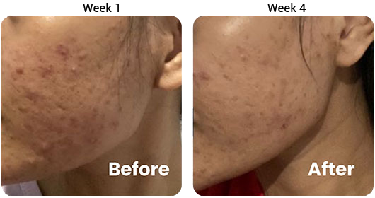 Testimonial 3-in-1 Acne Treatment Serum