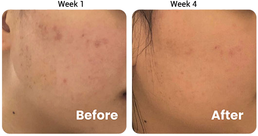 Testimonial 3-in-1 Acne Treatment Serum